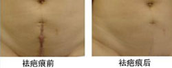去除疤痕特色療法