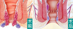 無刀除痔特色療法